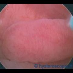 polype endocavitaire utérin polype endocavitaire utérin